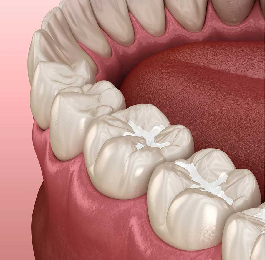 Dental-Sealants-model