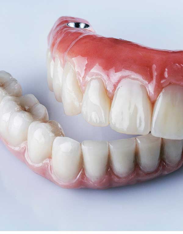 Implant-Supported-Dentures
