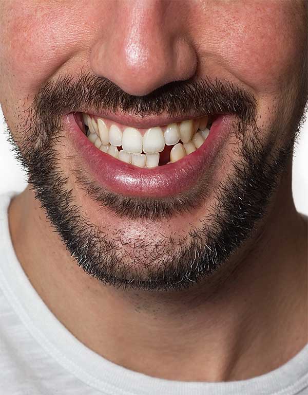Missing-or-Damaged-Teeth