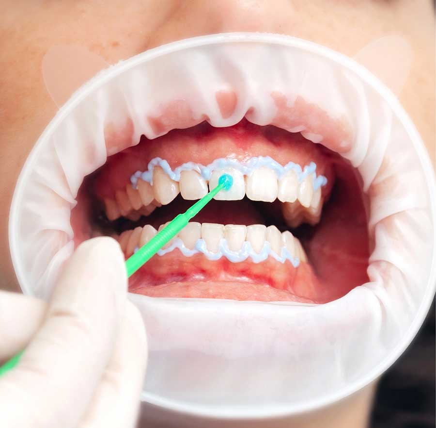 Teeth-Whitening-kit