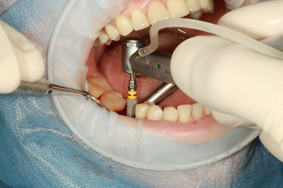 Essential information about dental implants
