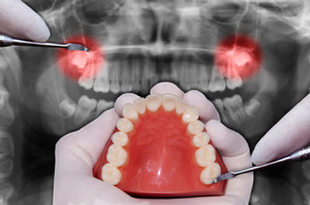 Everything you need to know about wisdom tooth removal
