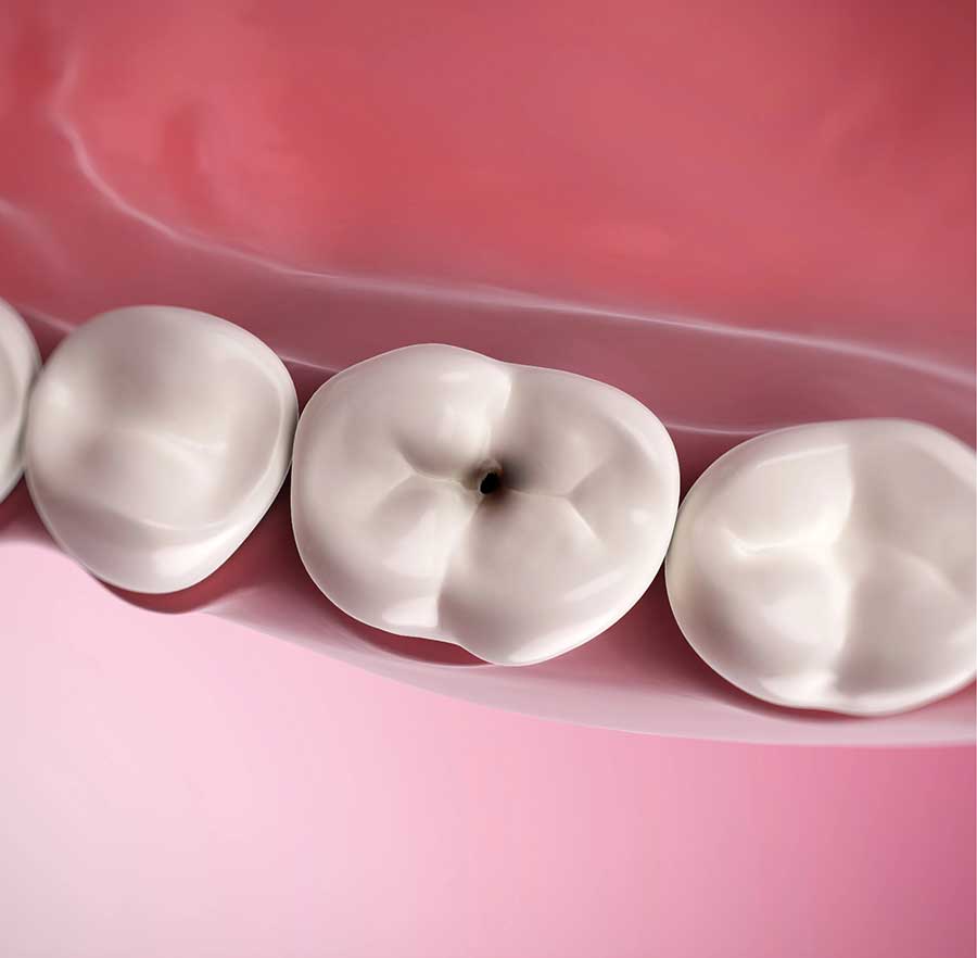 dental-fillings-importance