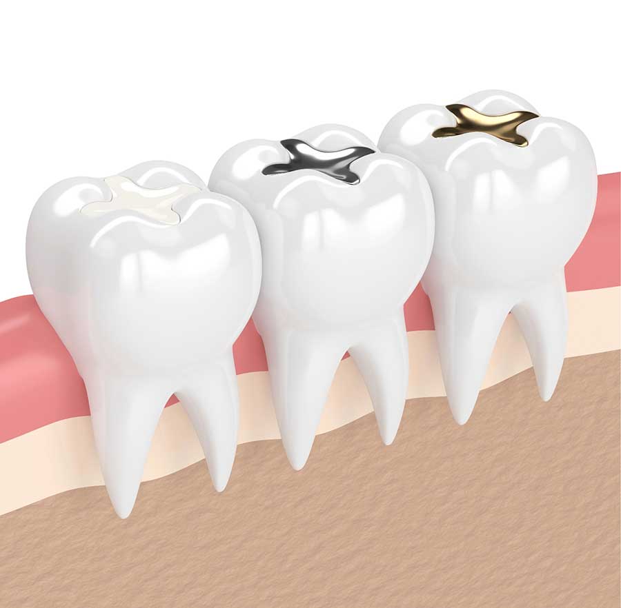 dental-fillings