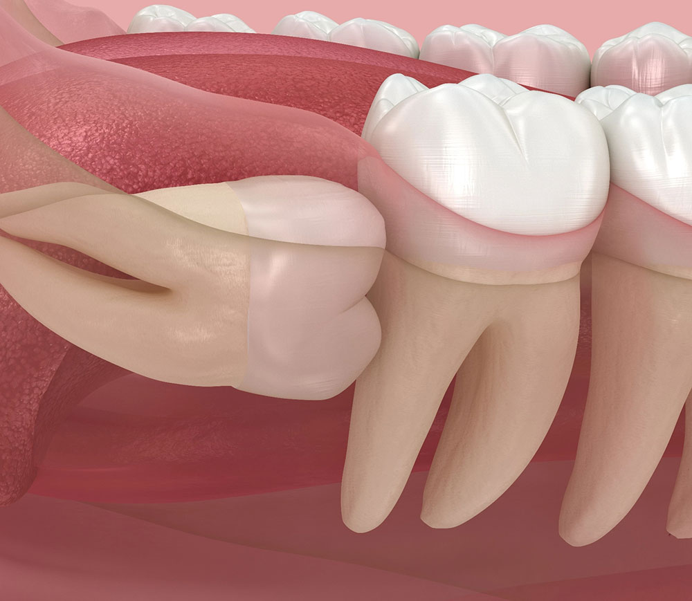 In grown wisdom tooth