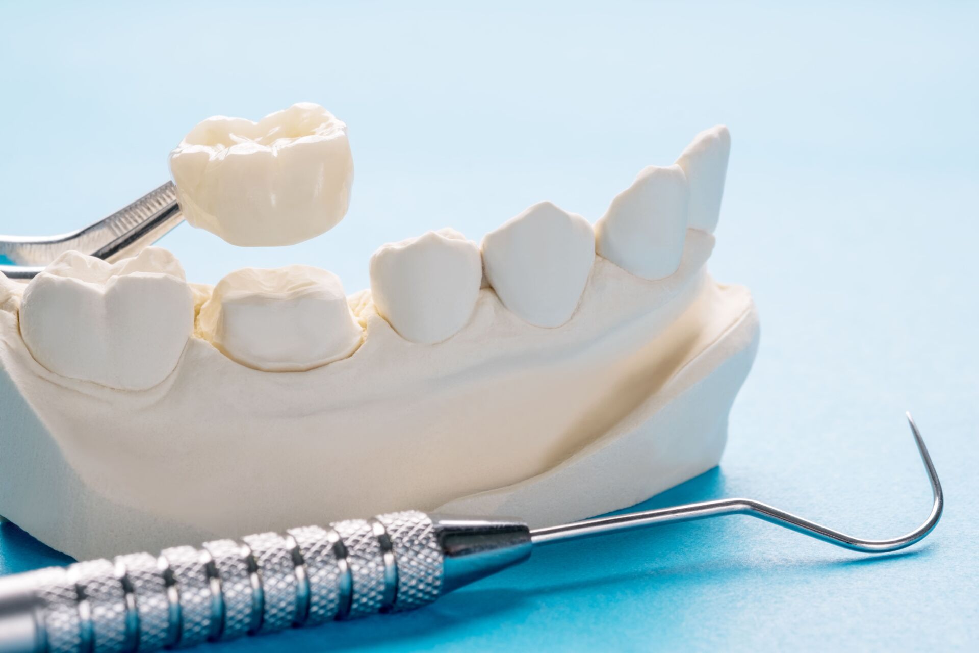Are Same-Day Crowns as Good as Regular Crowns?