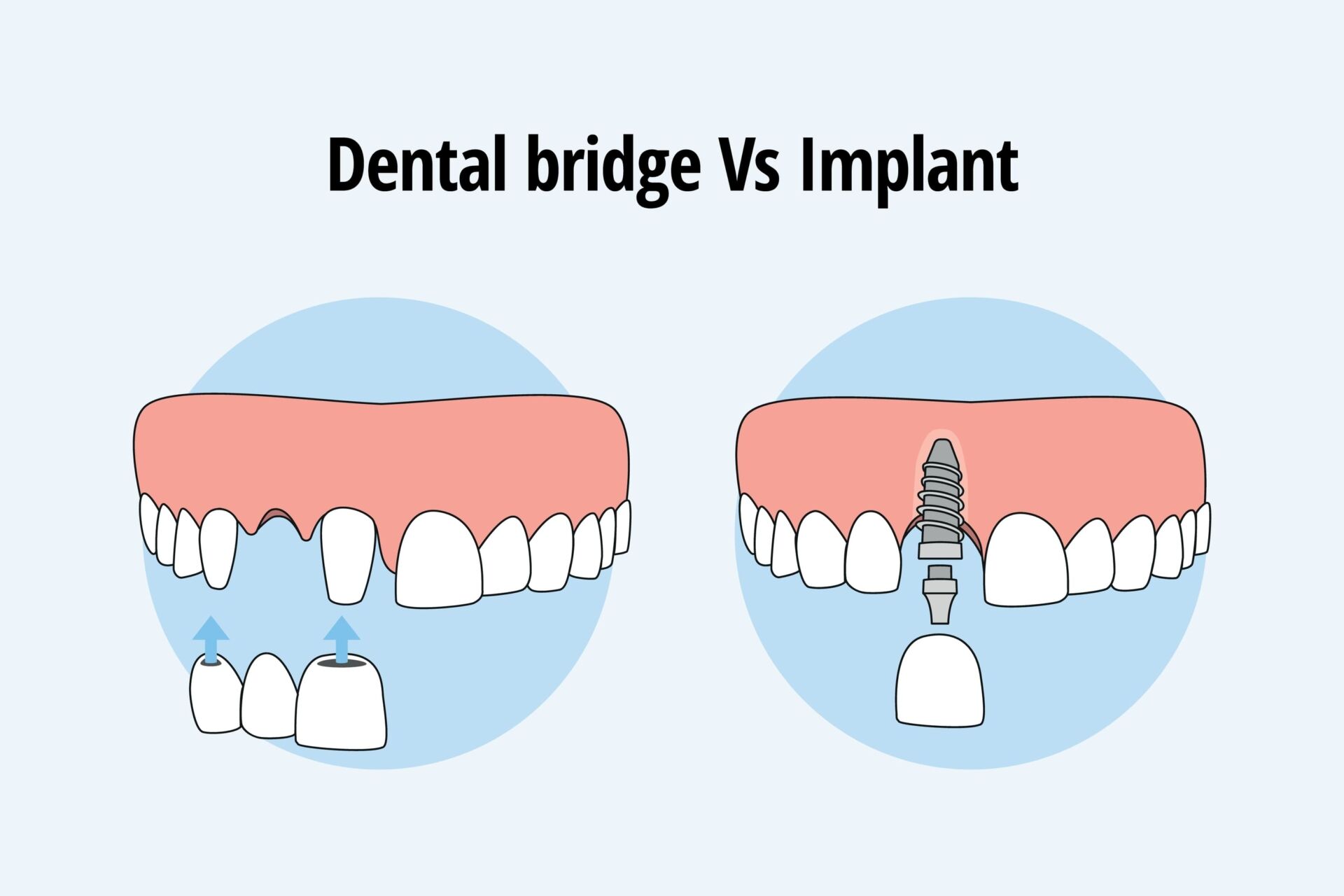 Dental Implants vs. Bridges