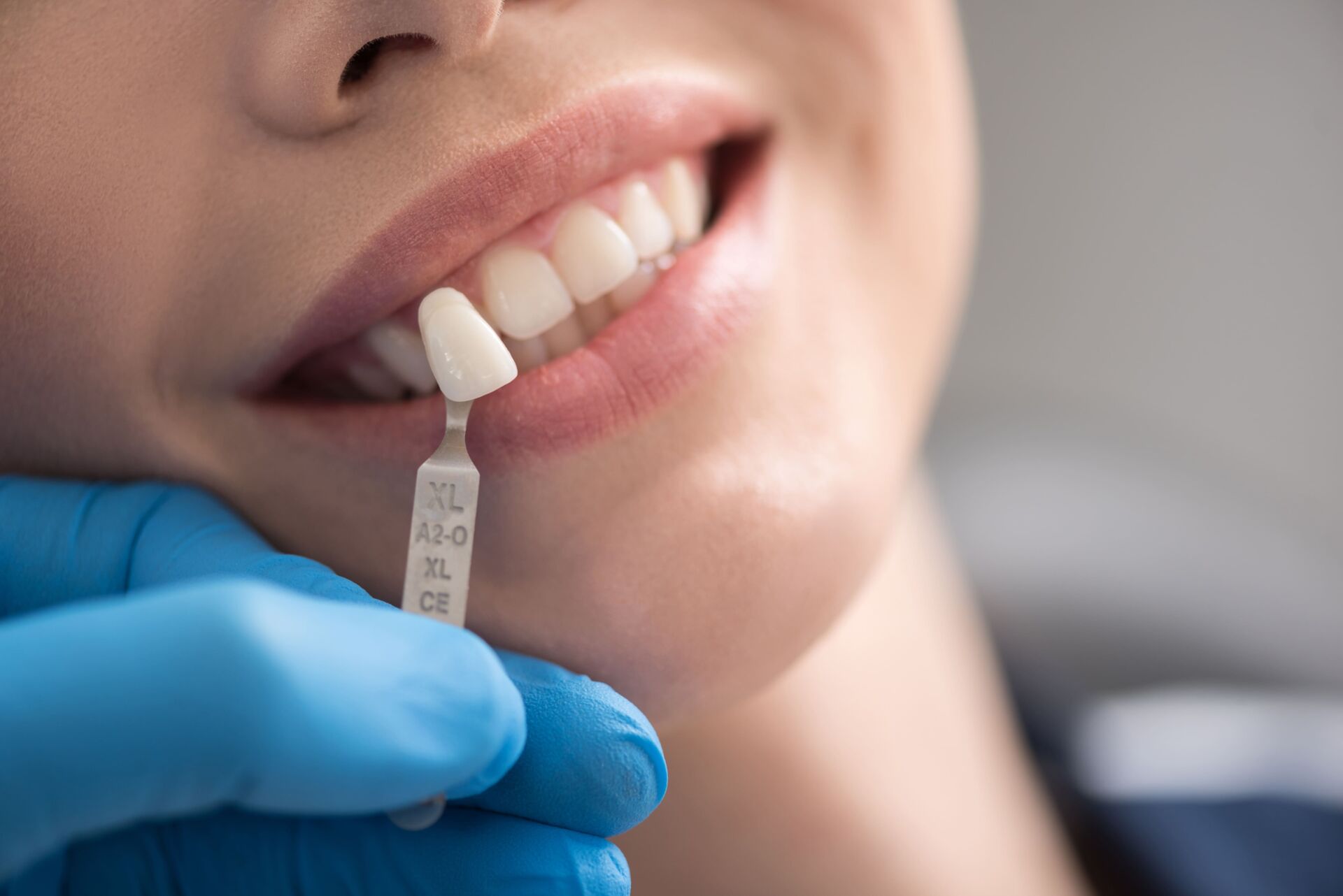 Common Signs You Need a Dental Crown